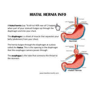 Diaphragmatic Hernia