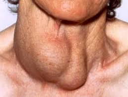 Iodine and Hashimotos Thyroiditis and Graves Disease Unknown