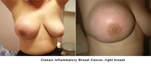 Organic Iodine And Fibrocystic Breast Lumps classic-inflammatory-breast-cancer