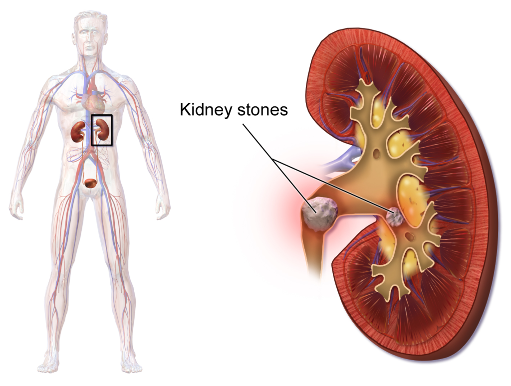 Discover The Frightening Truth about Cleansing Blausen_0595_KidneyStones