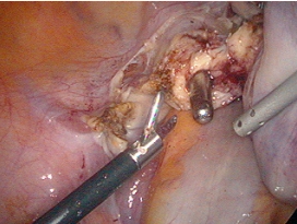 Hysterectomy: Power Morcellators jgeorgemd supracervical 11