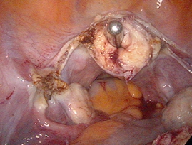 Hysterectomy: Power Morcellators jgeorgemd supracervical 21