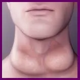 Hypothyroidism 1