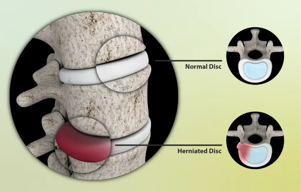 Herniated Disc Solution Herniated Disc