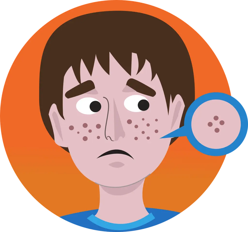 Are You Treating Acne the Wrong Way? acne 4254911 1280