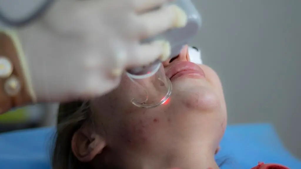Are You Treating Acne the Wrong Way? laser treatment 6664875 1280